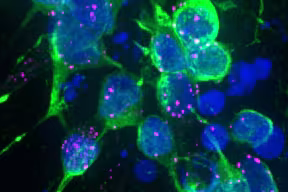 Dopaminergic neurons with tiny aggregates