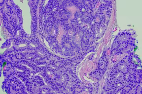 Prostatic adenocarcinoma, Gleason Pattern 4