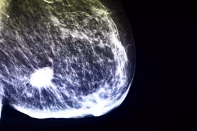 Mammogram showing breast cancer tumour