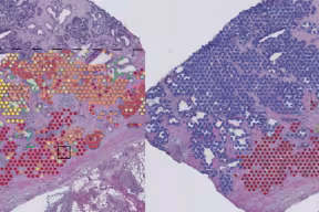 Genetic mapping of tumours reveals how cancers grow