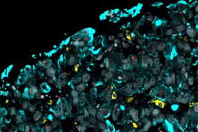 Oesophagal adenocarcinoma