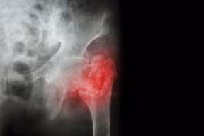 Image depicts an X-ray of a hip fracture