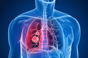 Lung cancer