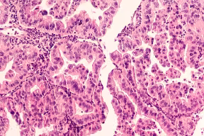 Ovarian cancer cells under a microscope